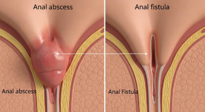 Anal abses yoxsa anal fistula?