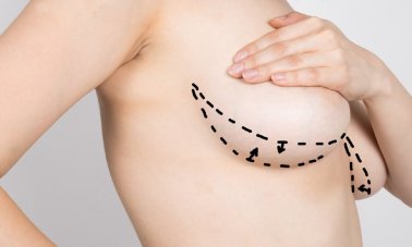 Döş kiçiltmə estetikasının sosial həyata təsirləri