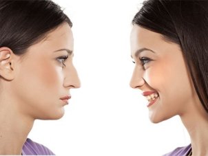 Rinoplastika nədir və necə tətbiq olunur?