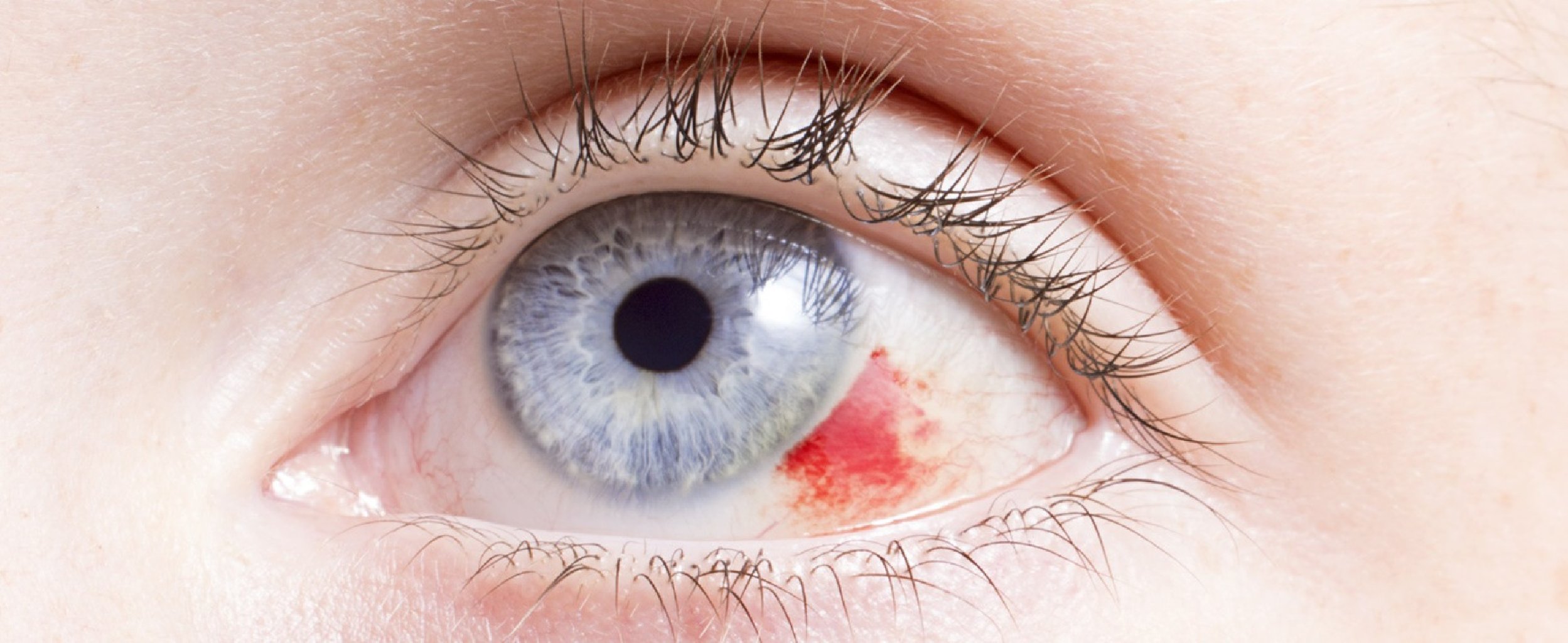 Aşagi goz qapaginin cevrilmesi