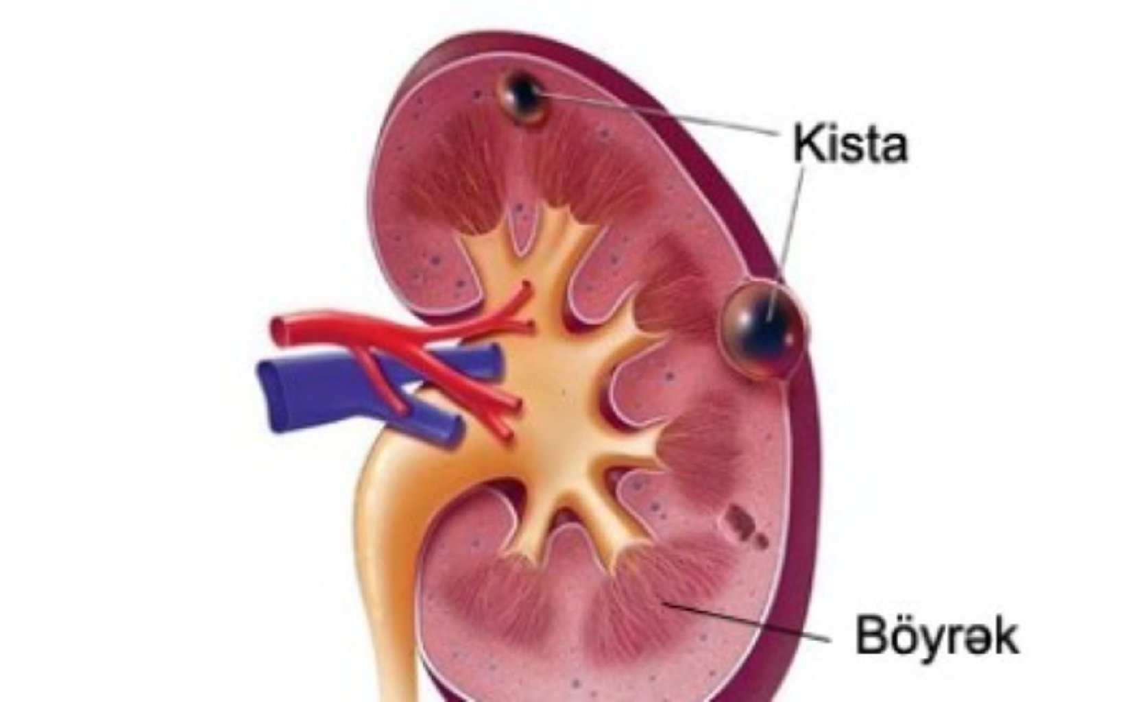 Böyrək kistaları nədir? müalicə üsulları