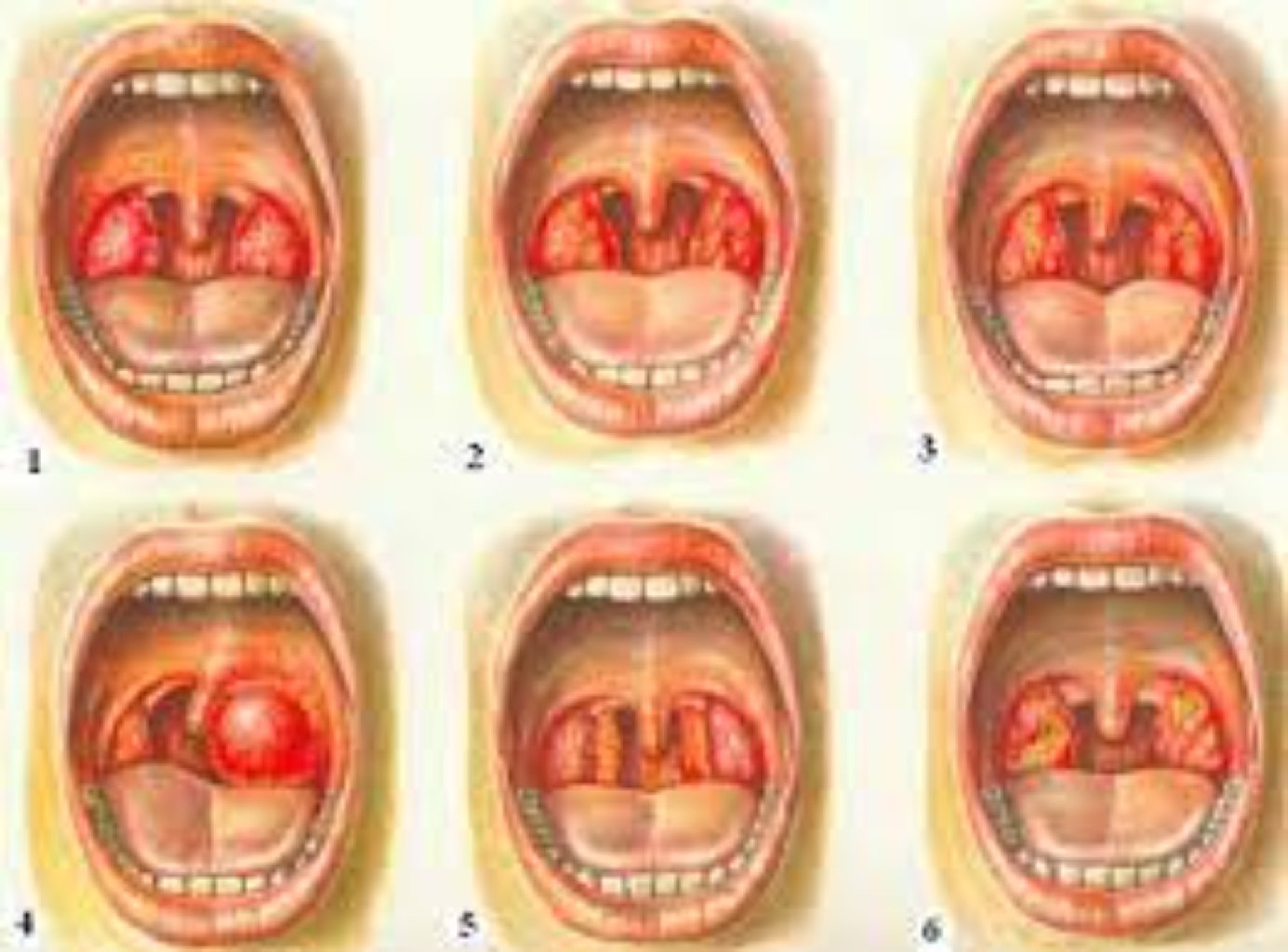Tonzillektomiya haqqında