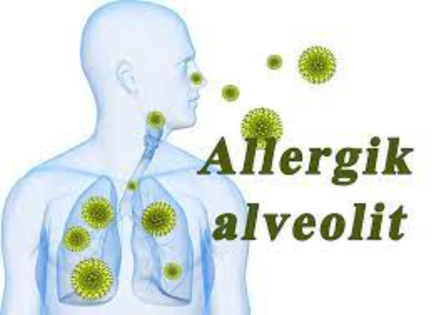 Allergik alveolit