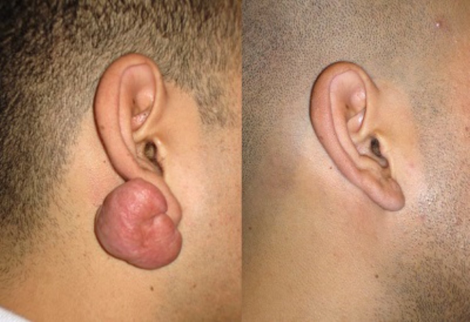 Qulaq seyvanından xoşxasssəli törəmələrin götürülməsi (keloid, lipoma və s)