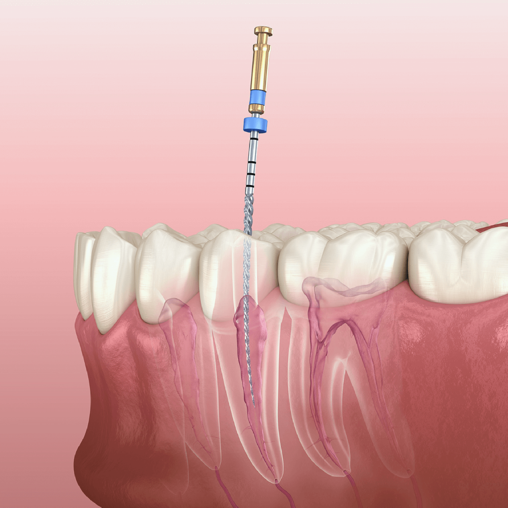 Kök ucu rezeksiyası