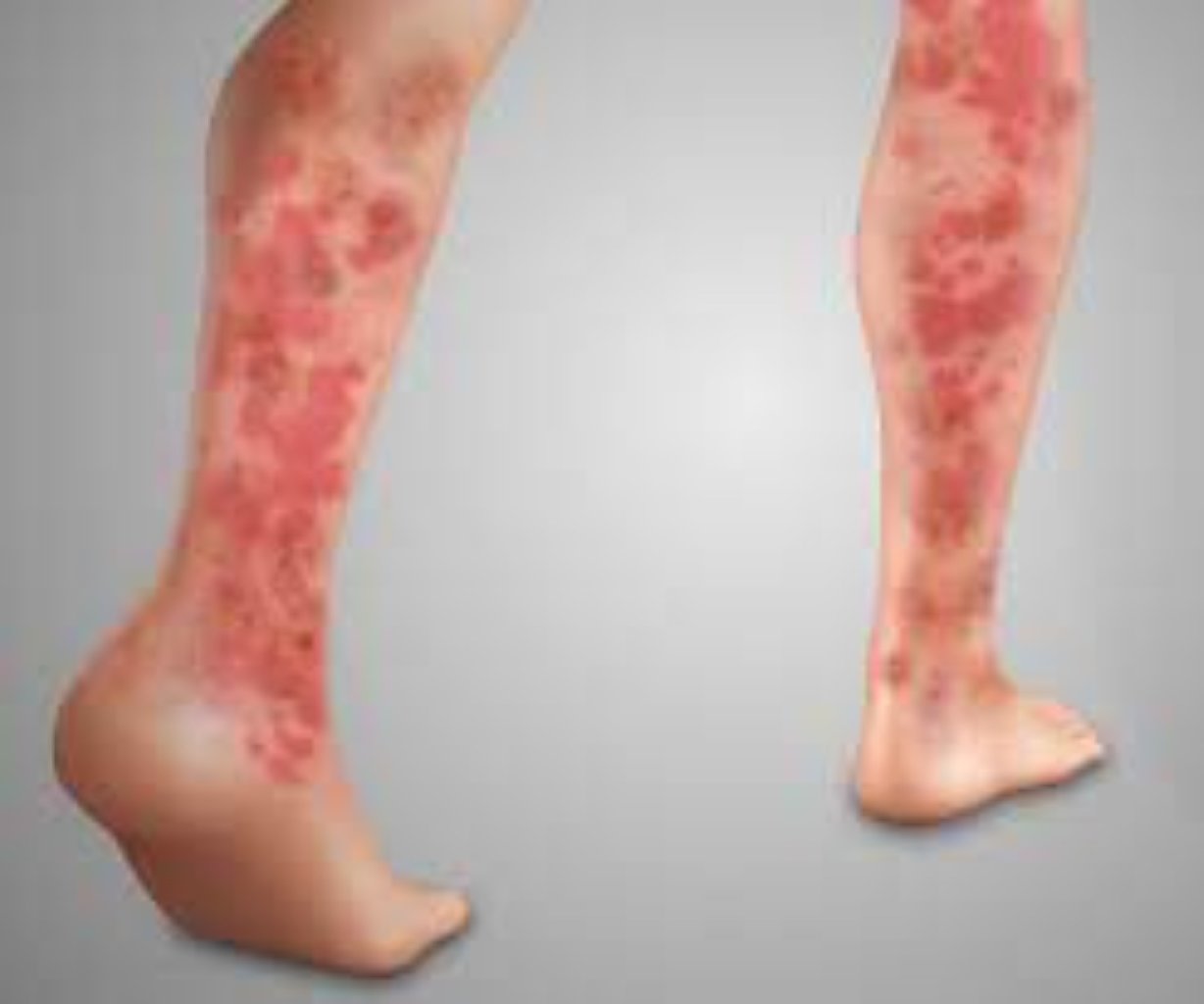 Allergik enteropatiya