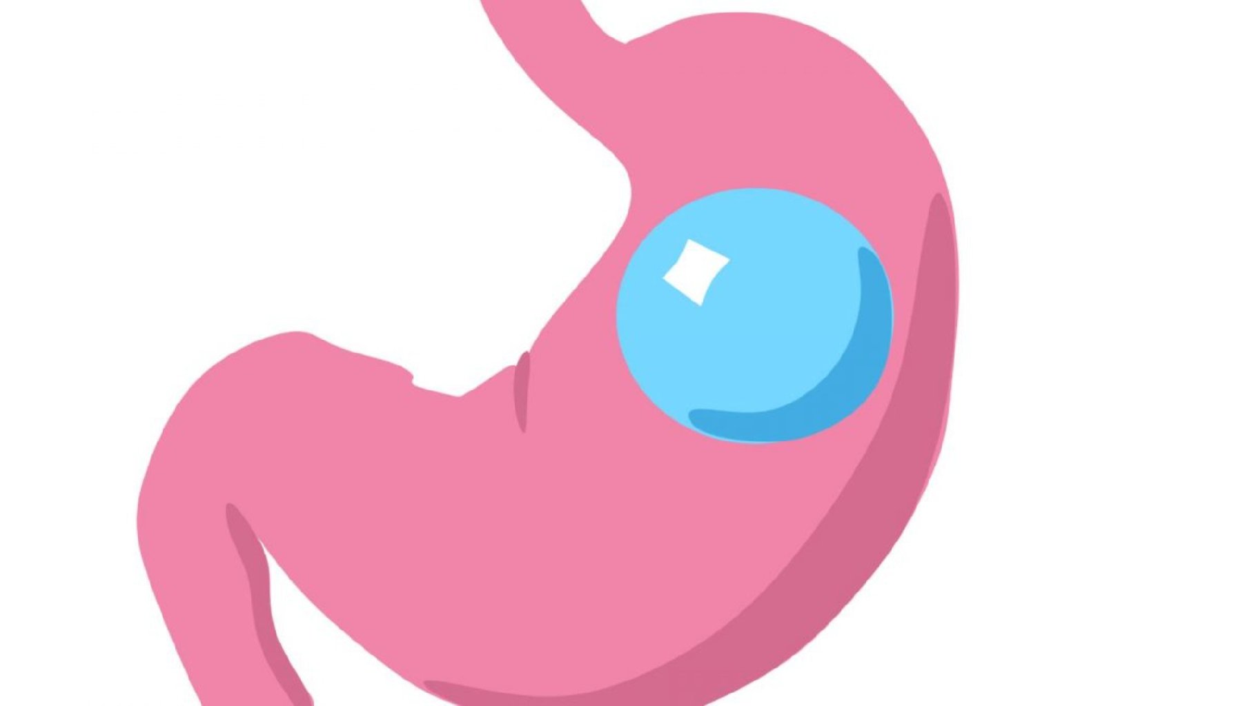 Mədə balonunun yerləşdirilməsi