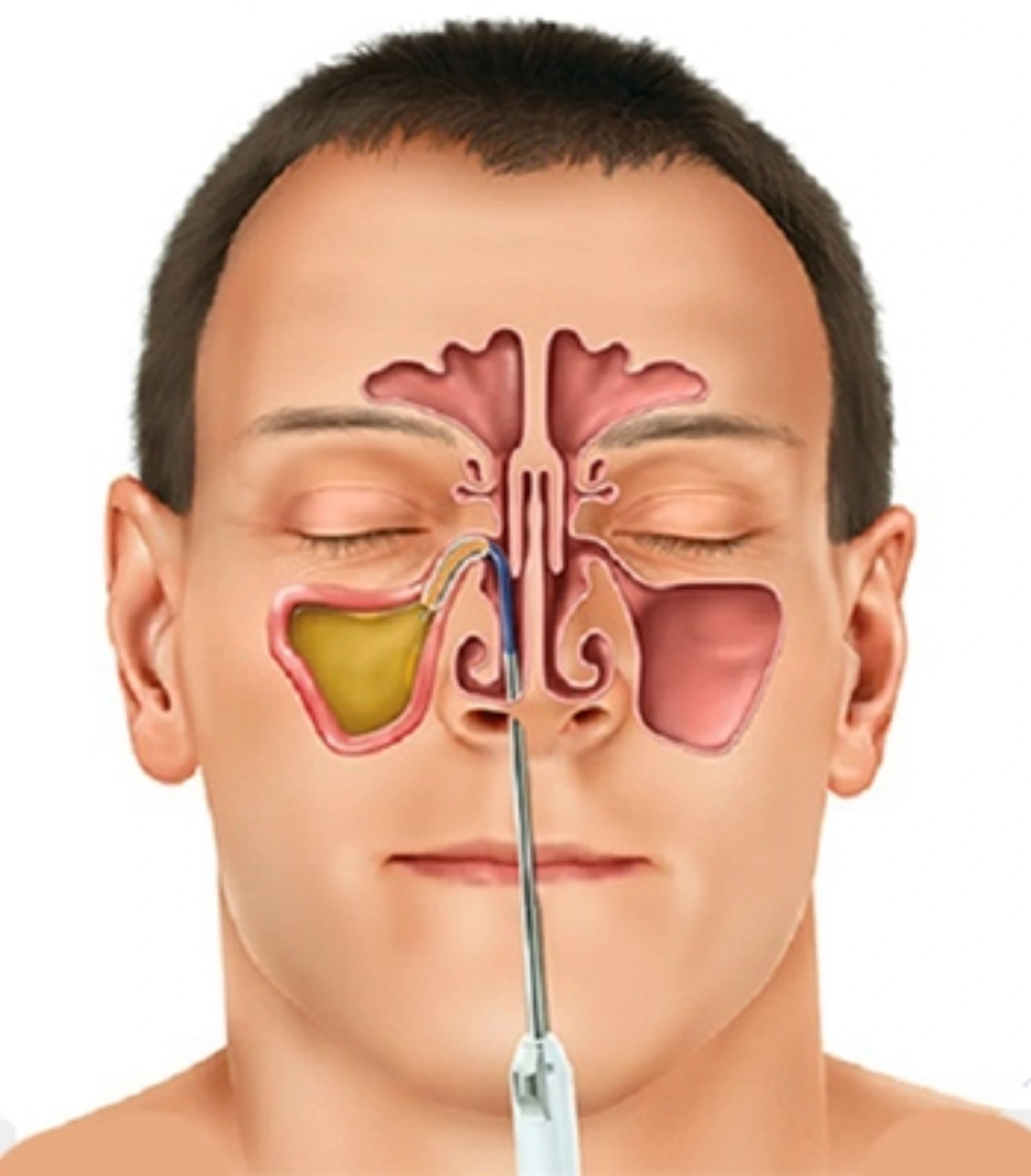 Sinuzit: Əlamətlər, Müalicə və Qoruma