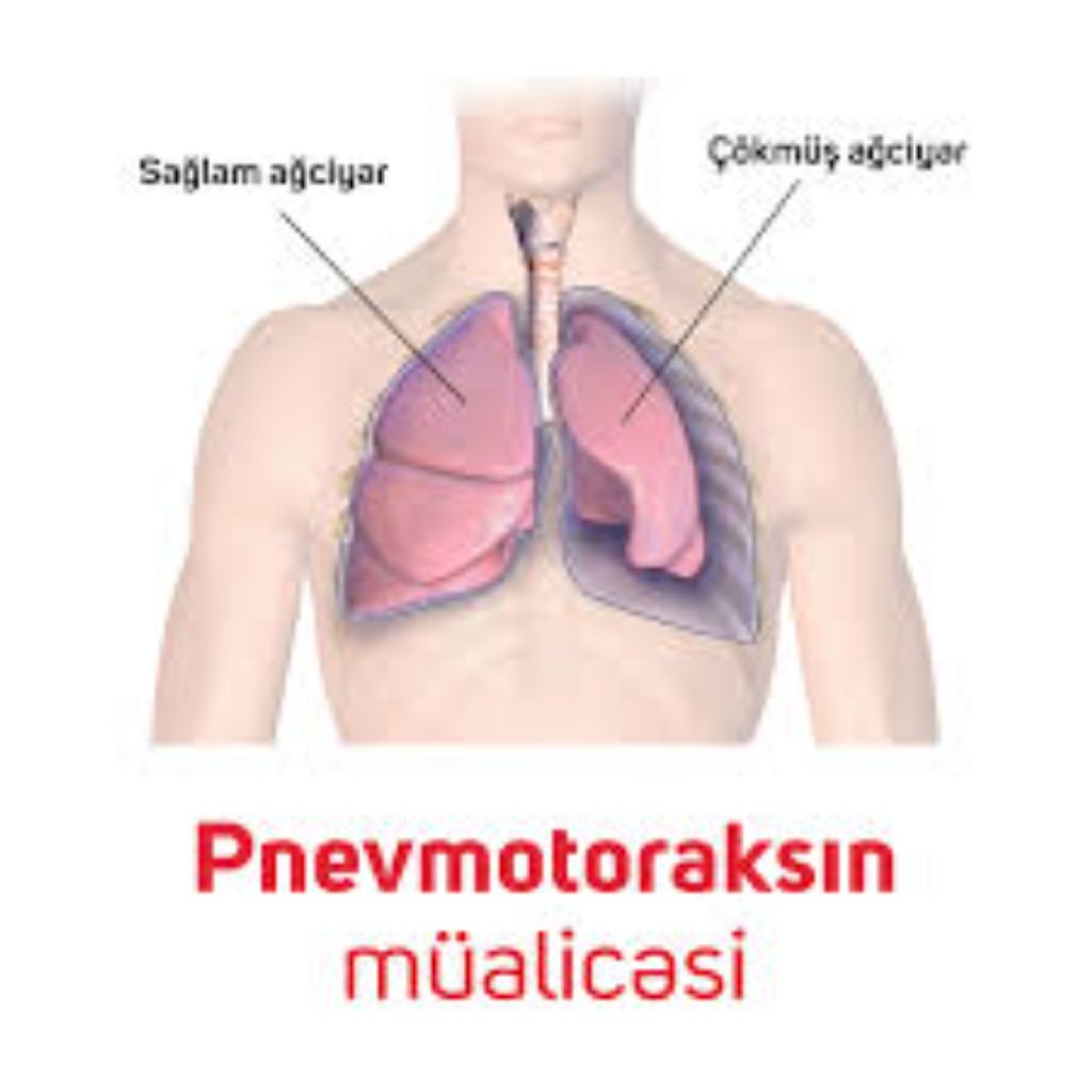 Birincil və ikincil pnevmotoraks - qazların, plevrə havanın yığılması