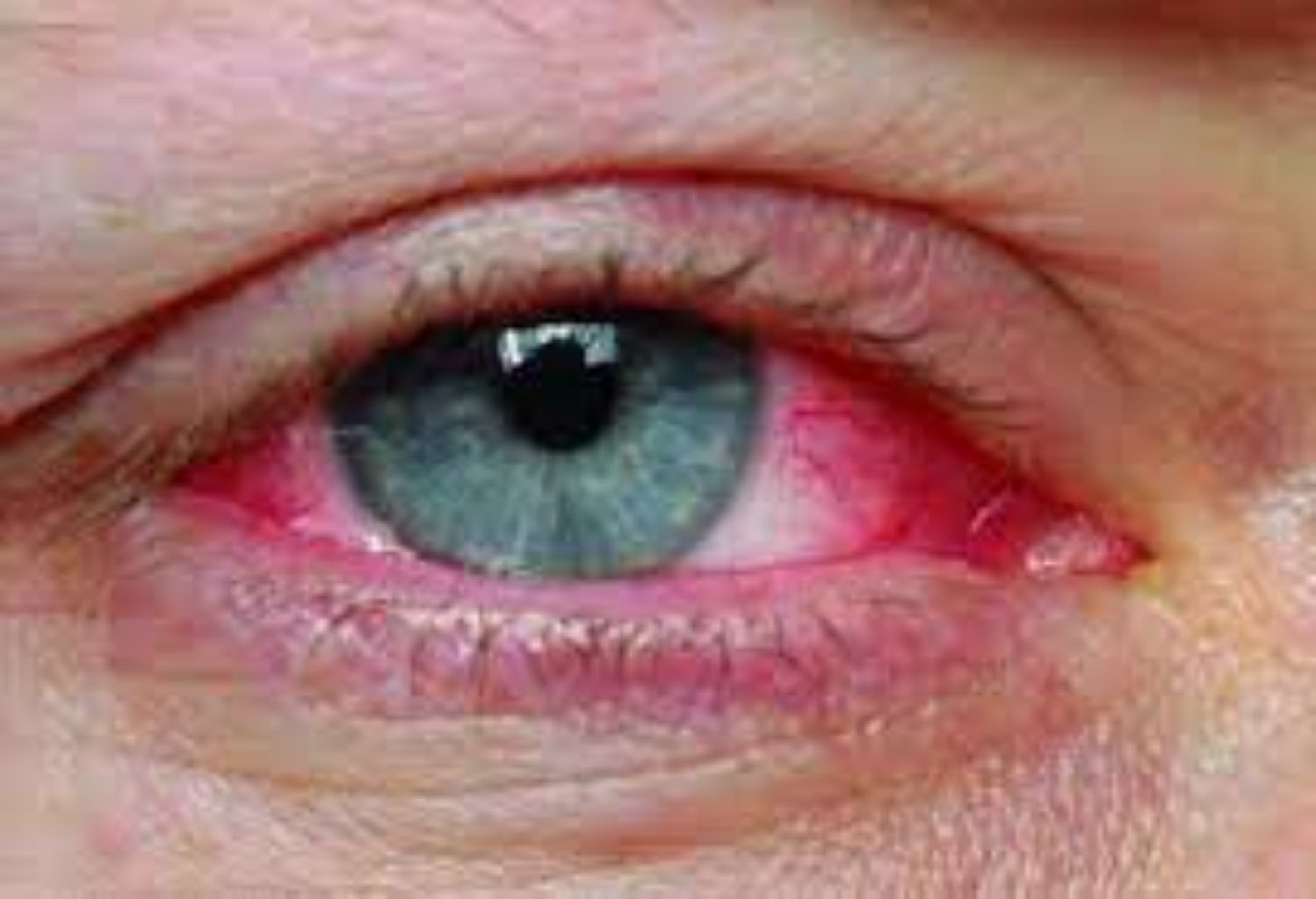 Anqulyar konyunktivit