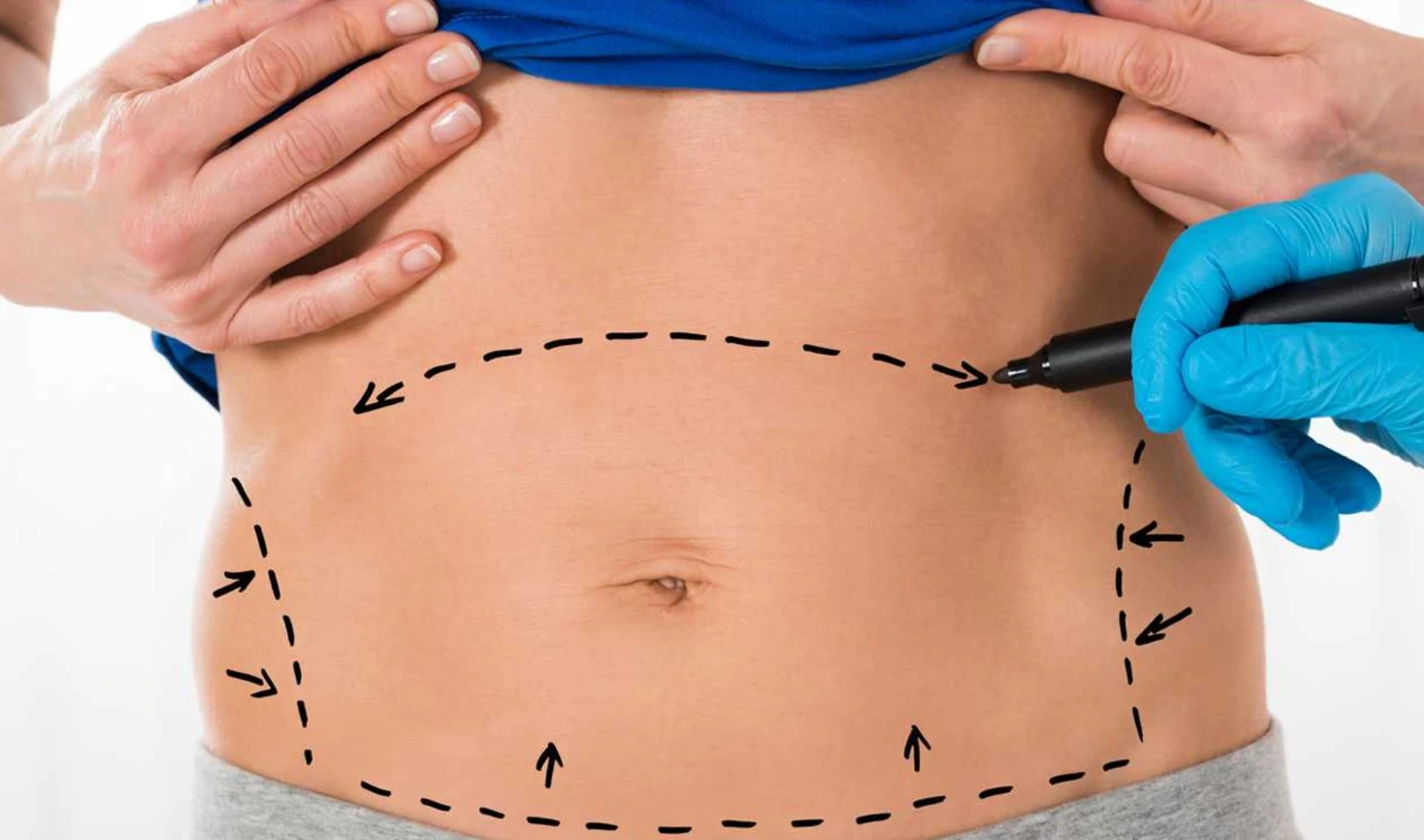 Abdominoplastika: Qarın Estetiği və Funksional Korreksiya Cərrahiyyəsi