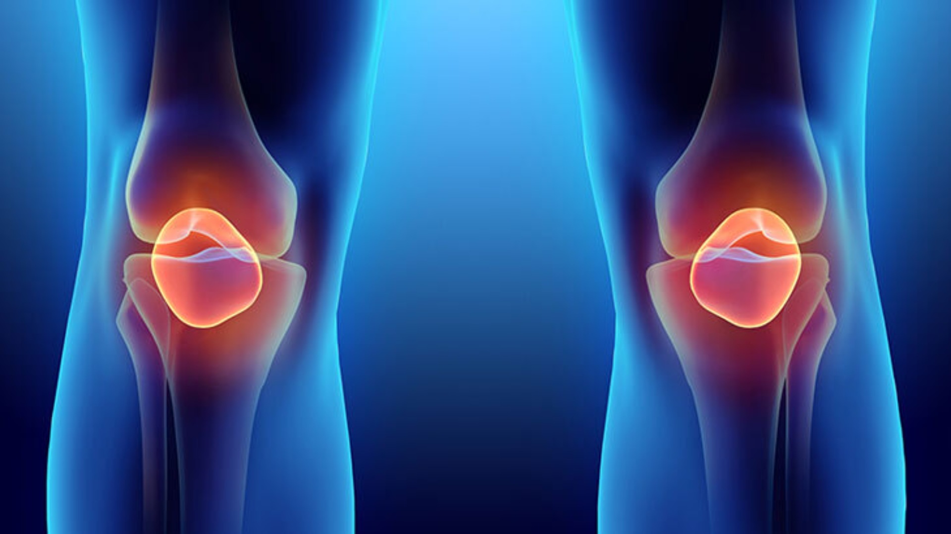 Artrit: nədir, simptomları və müalicəsi