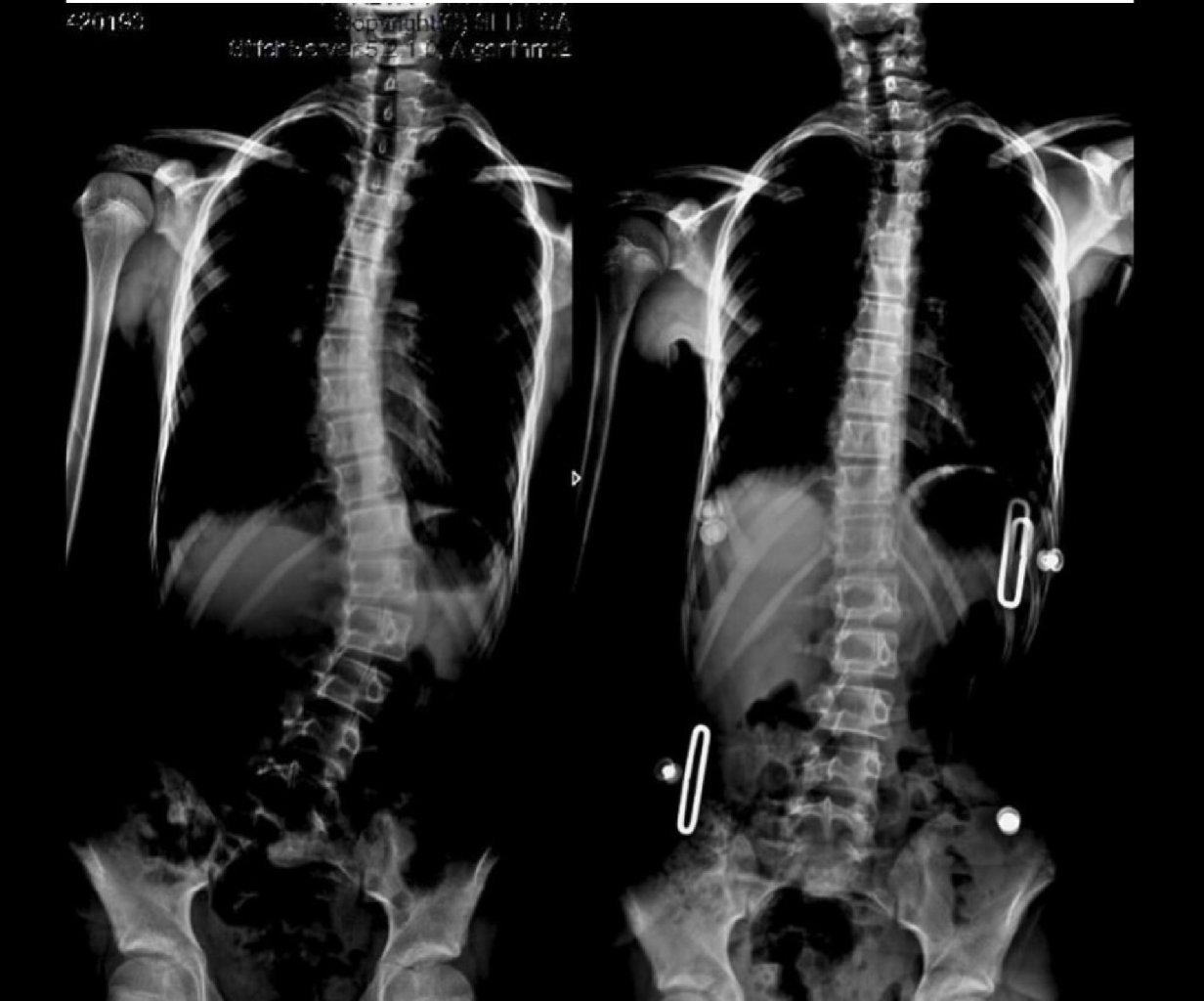 Skolyozda braket müalicəsi