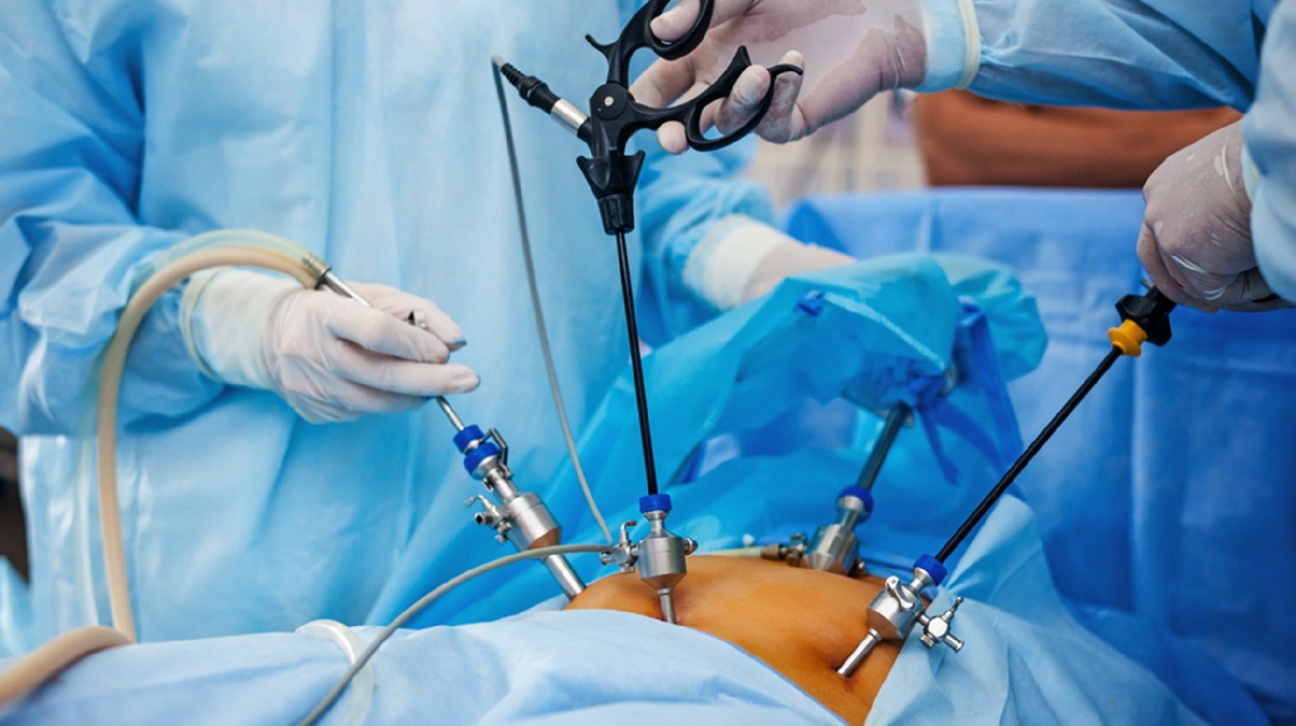 Laparoskopik Cərrahiyyə