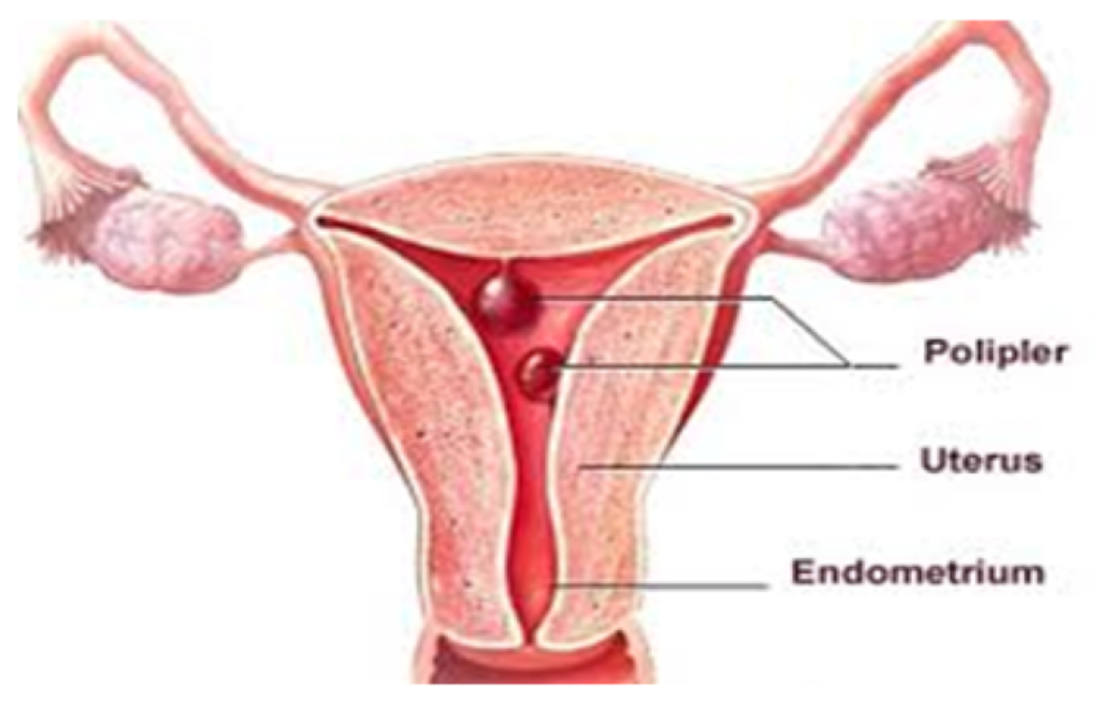 Uşaqlıq boynunun patologiyaları (eroziya, polip, endometrioz)