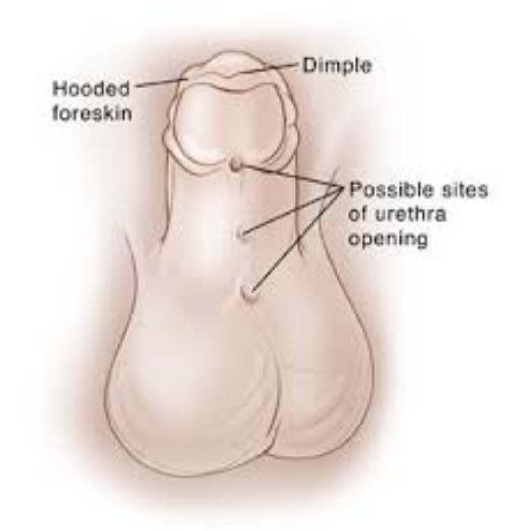 Sünnet Derisinin Şişmesi və ya Qızarması: Səbəbləri, Simptomları və Müalicə Yolları