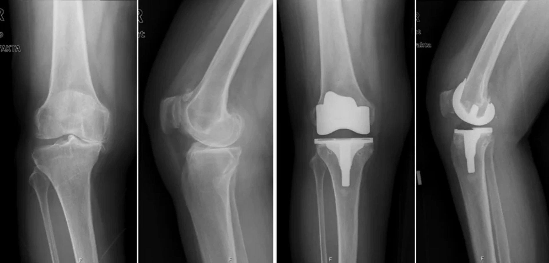 Diz Artroplastiyası: Birgə Sağlamlığı Bərpa edən Cərrahi Müdaxilə