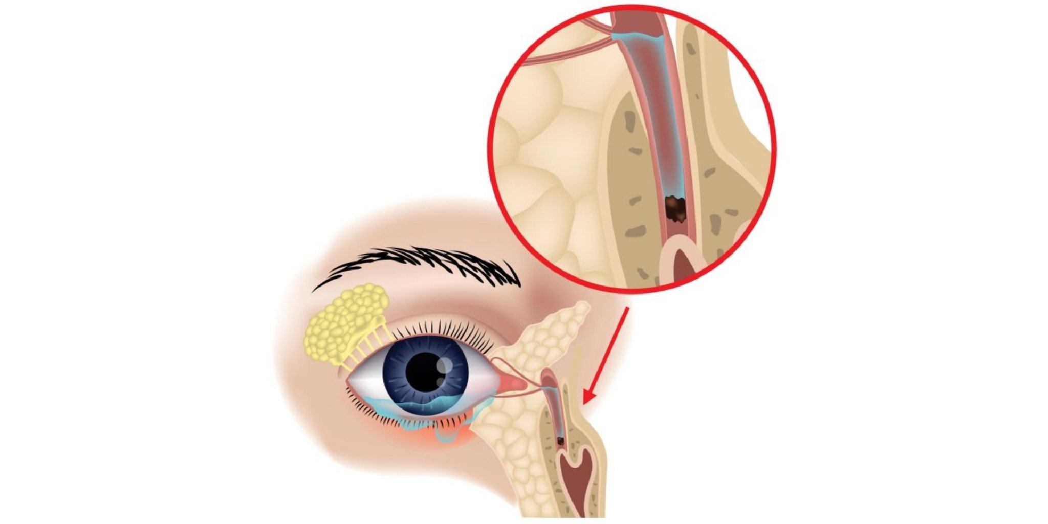 Gözyaşardıcı kanalın tıxanması