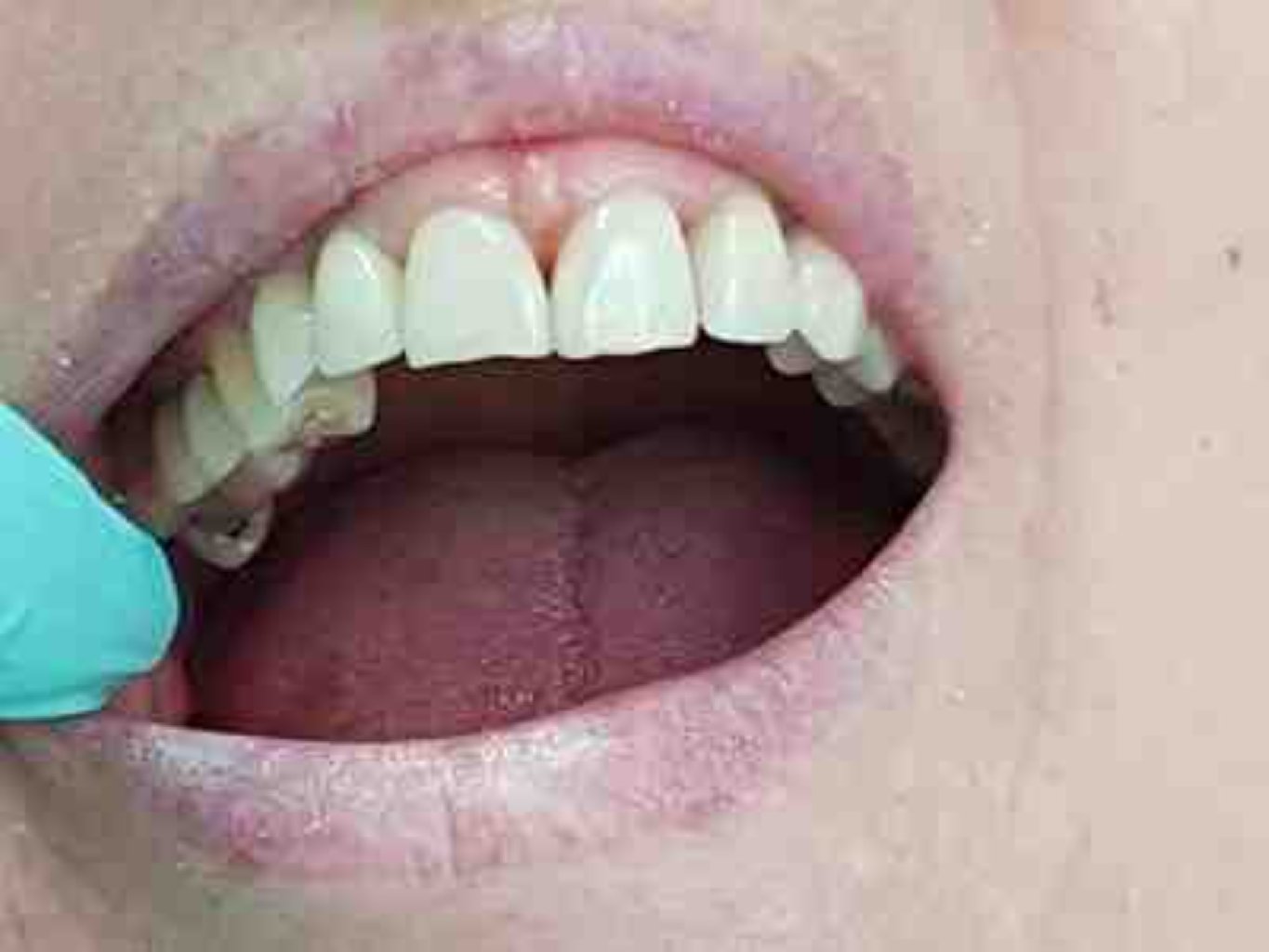 Dişlərin bərk toxumalarının hər növ terapiyası