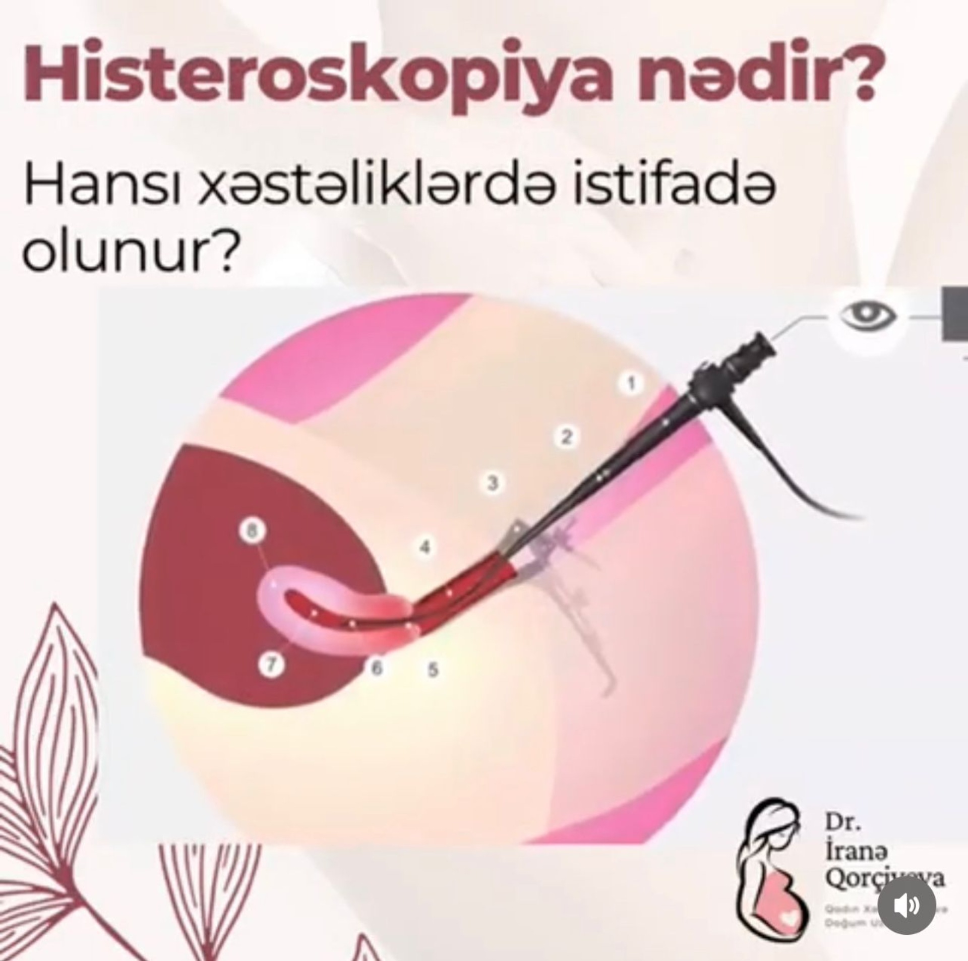 Histeroskopiya Nədir? makalesi