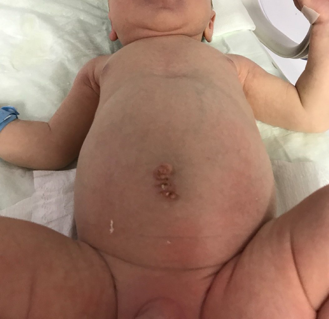 Onfalocele: Anadangəlmə İnkişaf Qüsurlarına Örnək