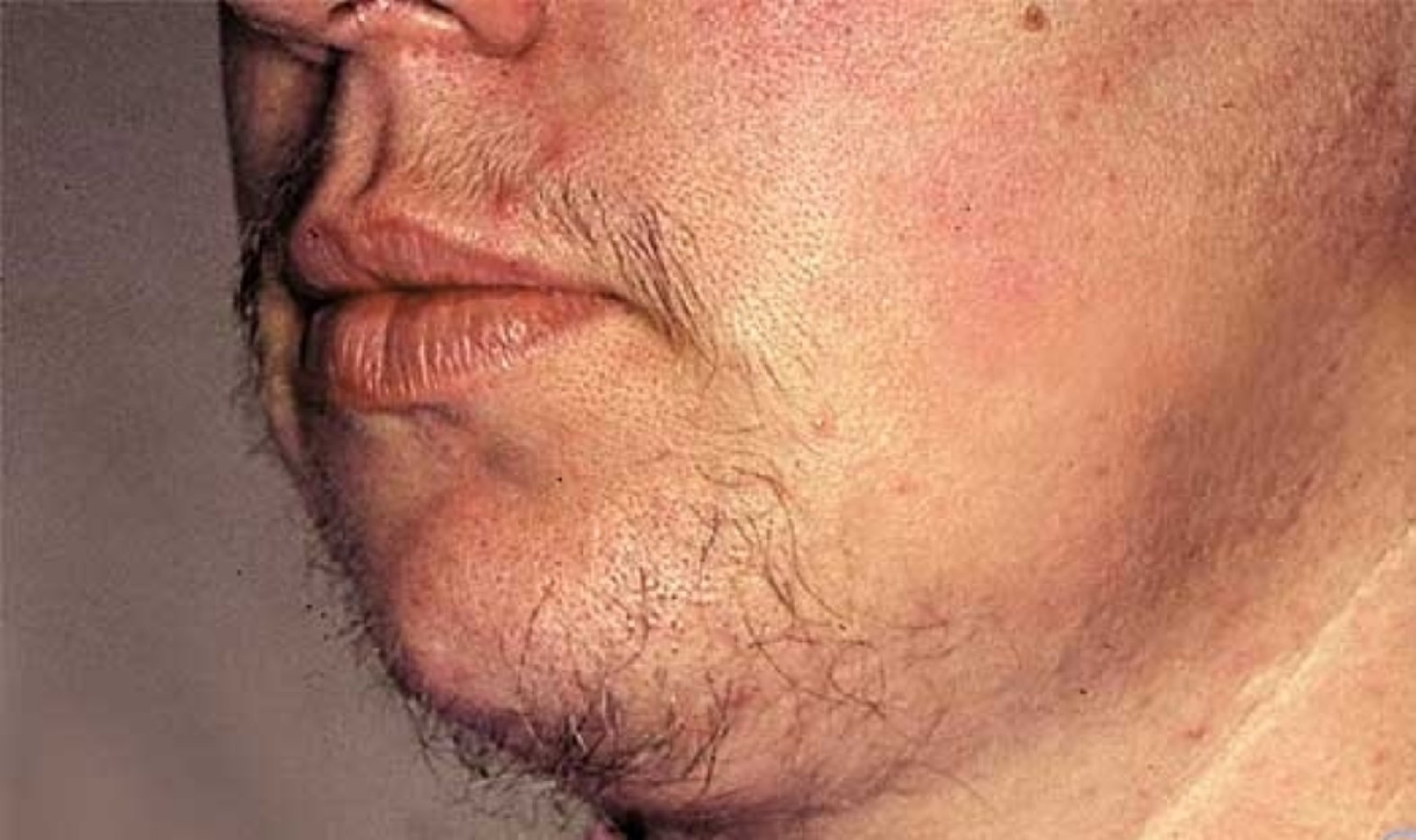 Artıq tüklənmə haqqında