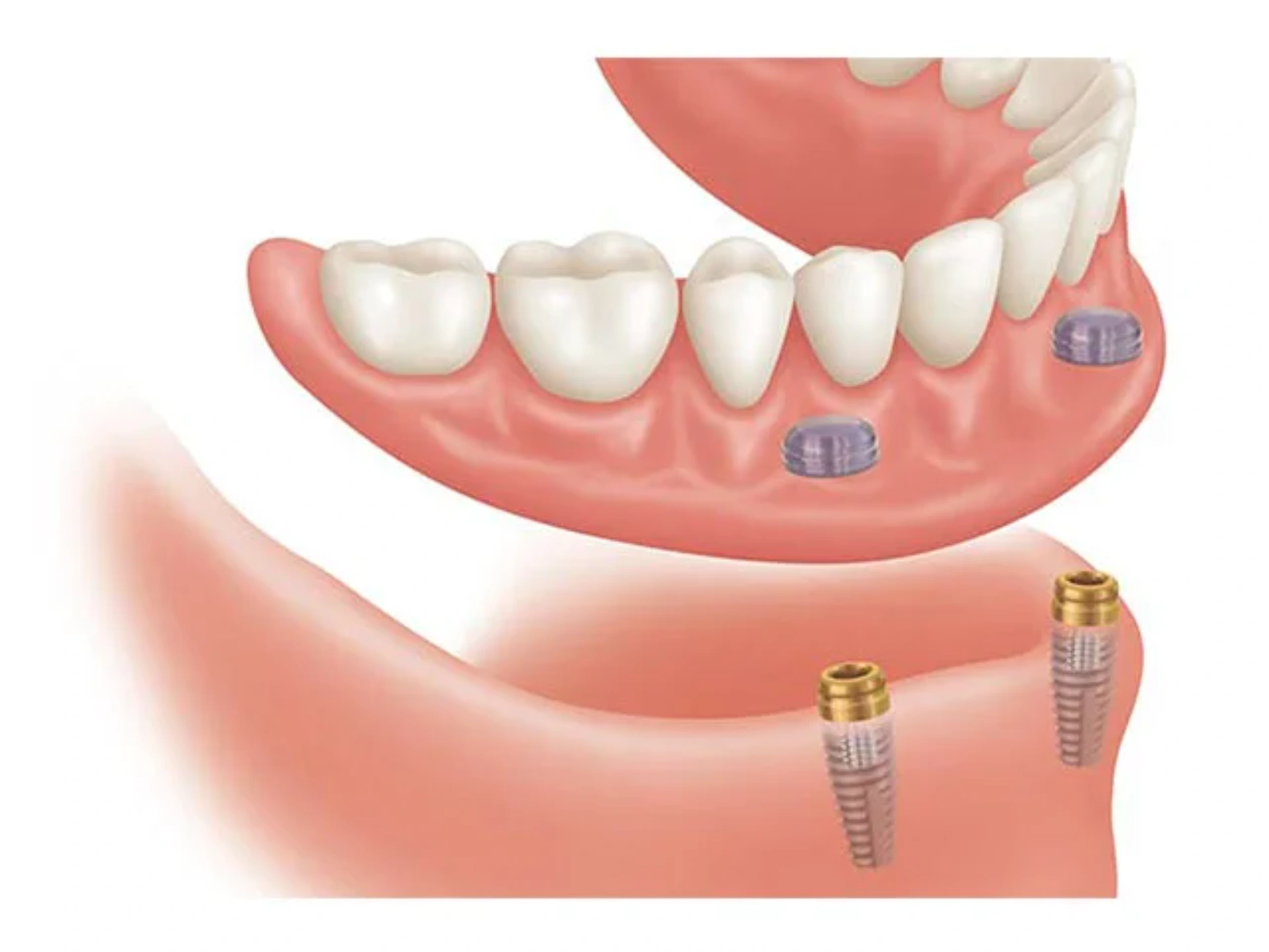 Müxtəlif növ hərəkətli (taxılıb-çıxarılan) protezlər
