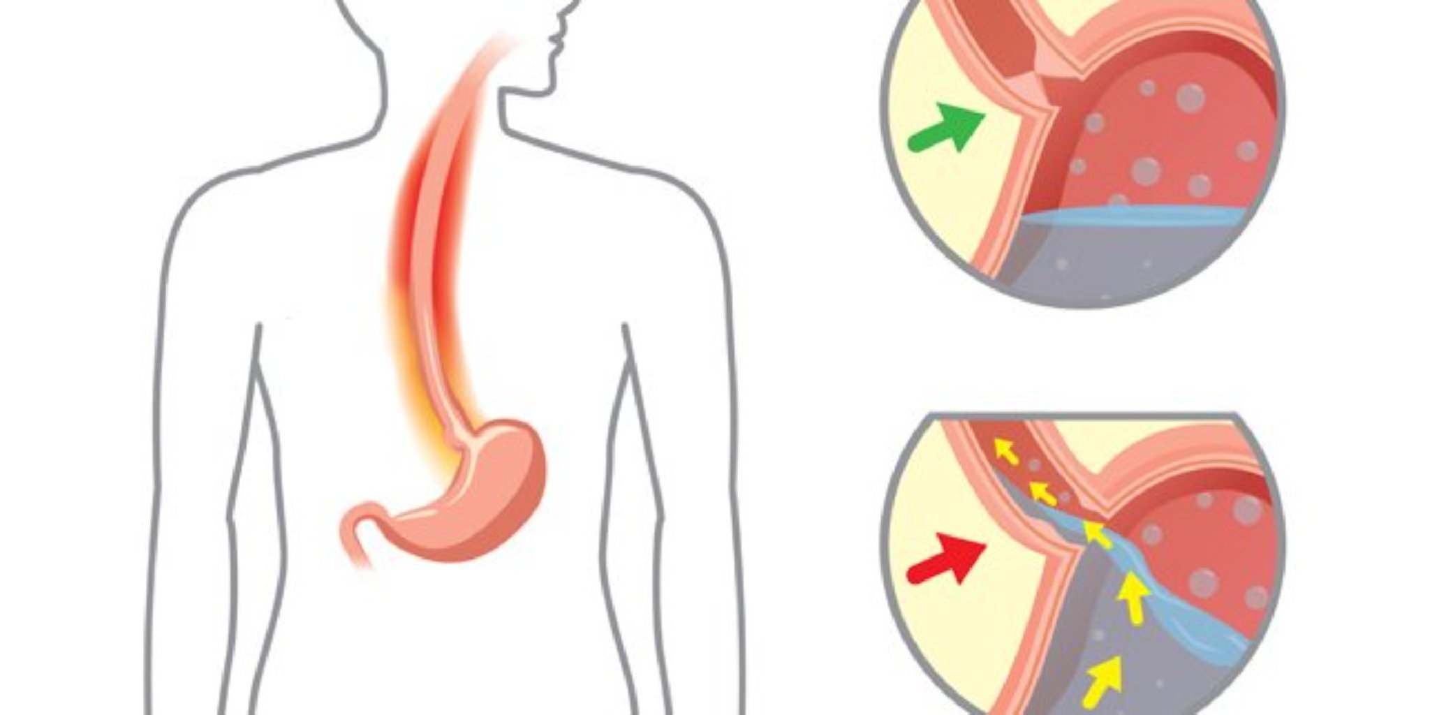 Qastroezofageal reflü xəstəliyi (GERD)