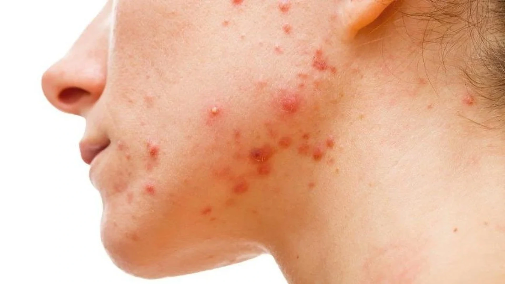 Yeniyetmələrin üzləşdiyi sızanaq problemi - necə müalicə olunur?