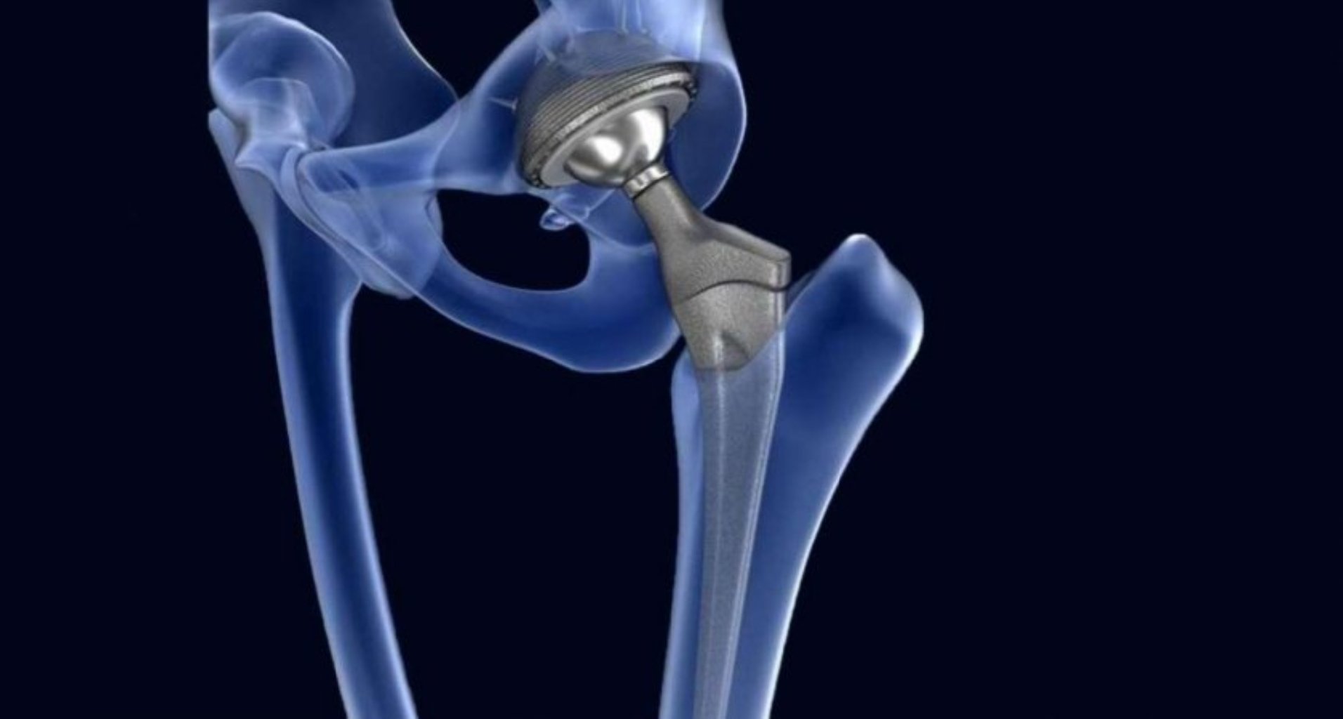 Omba Sağlamlığını Yaxşılaşdıran Protezlər