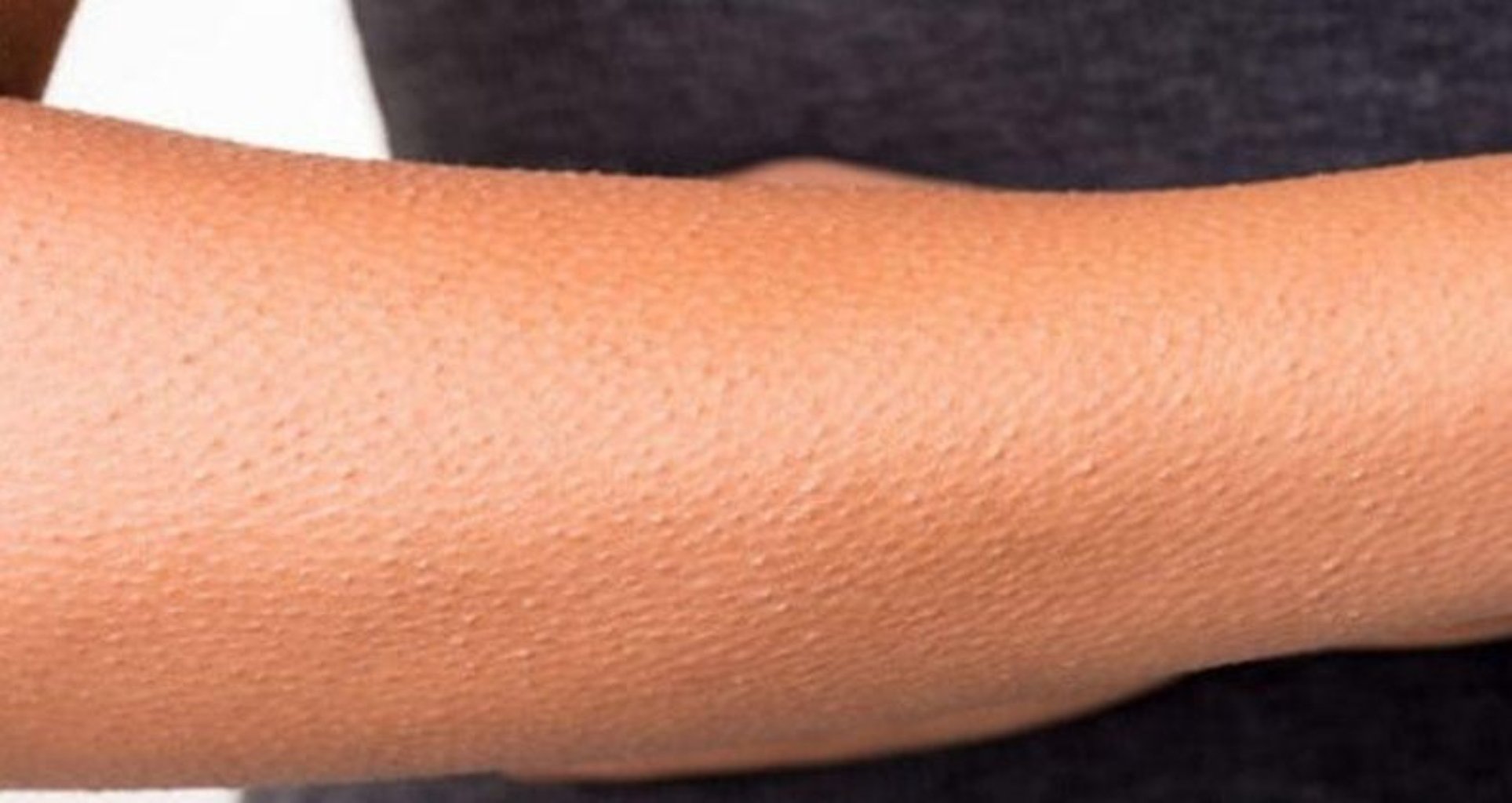 Follikulyar hiperkeratoz nədir?