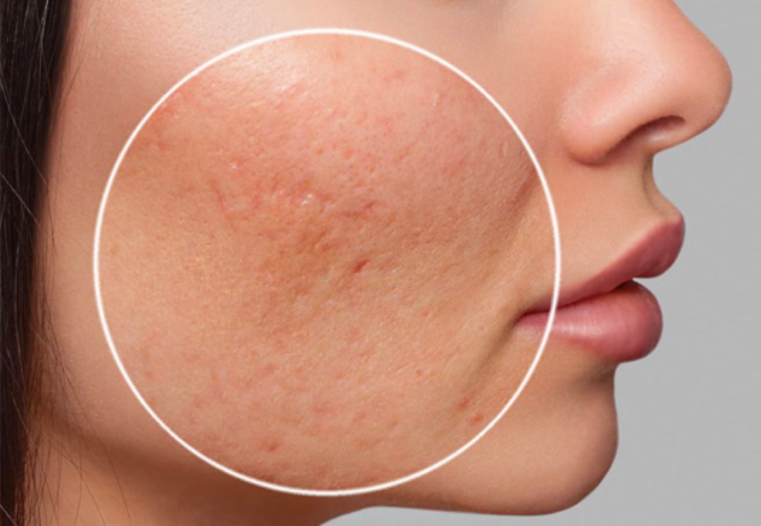 Sızanaq və sızanaq izlərinin müalicəsi makalesi