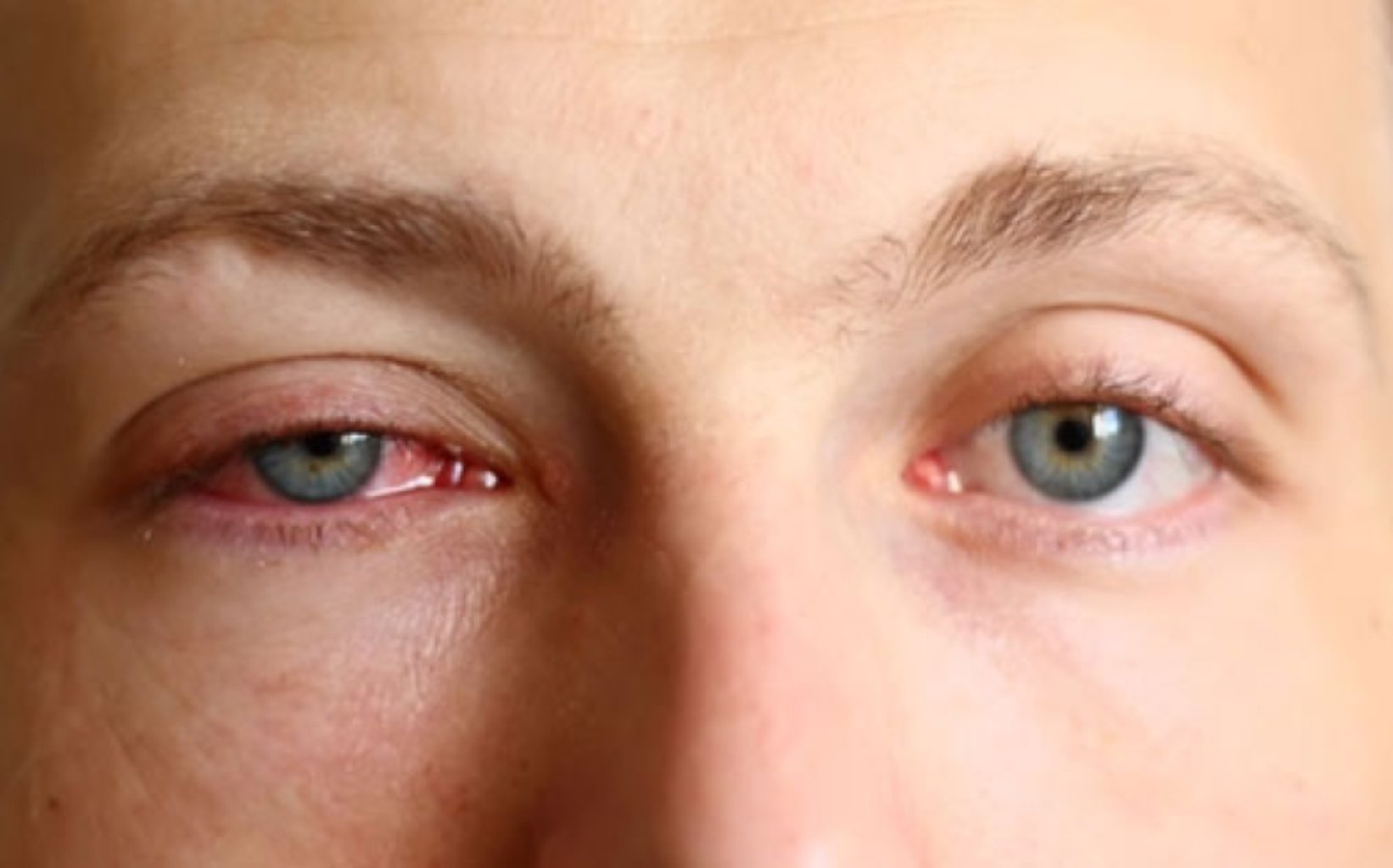 Allergik rinokonyuktivit