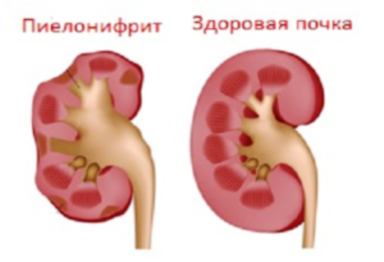 Pielonefrit xesteliyi
