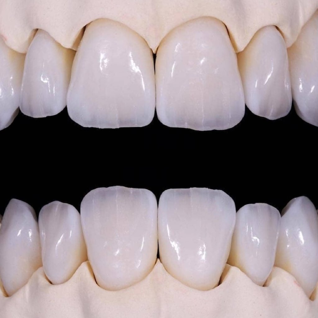 Tam seramik qapaqlar