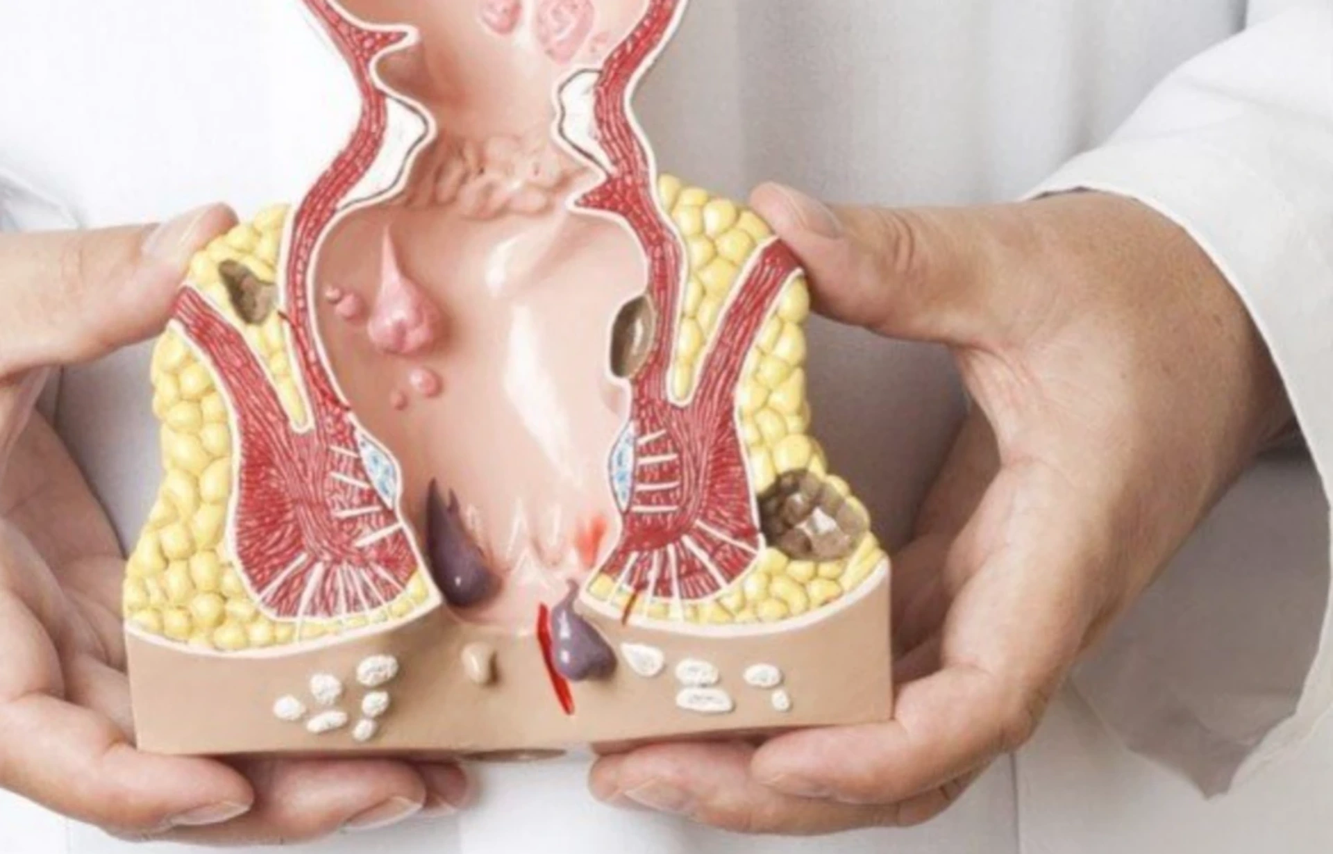 Anal Nahiyə Xəstəlikləri: Diaqnoz, Simptomlar və Müalicə