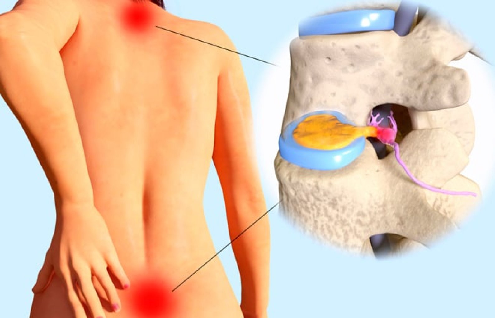 Bel yırtığı əməliyyatı