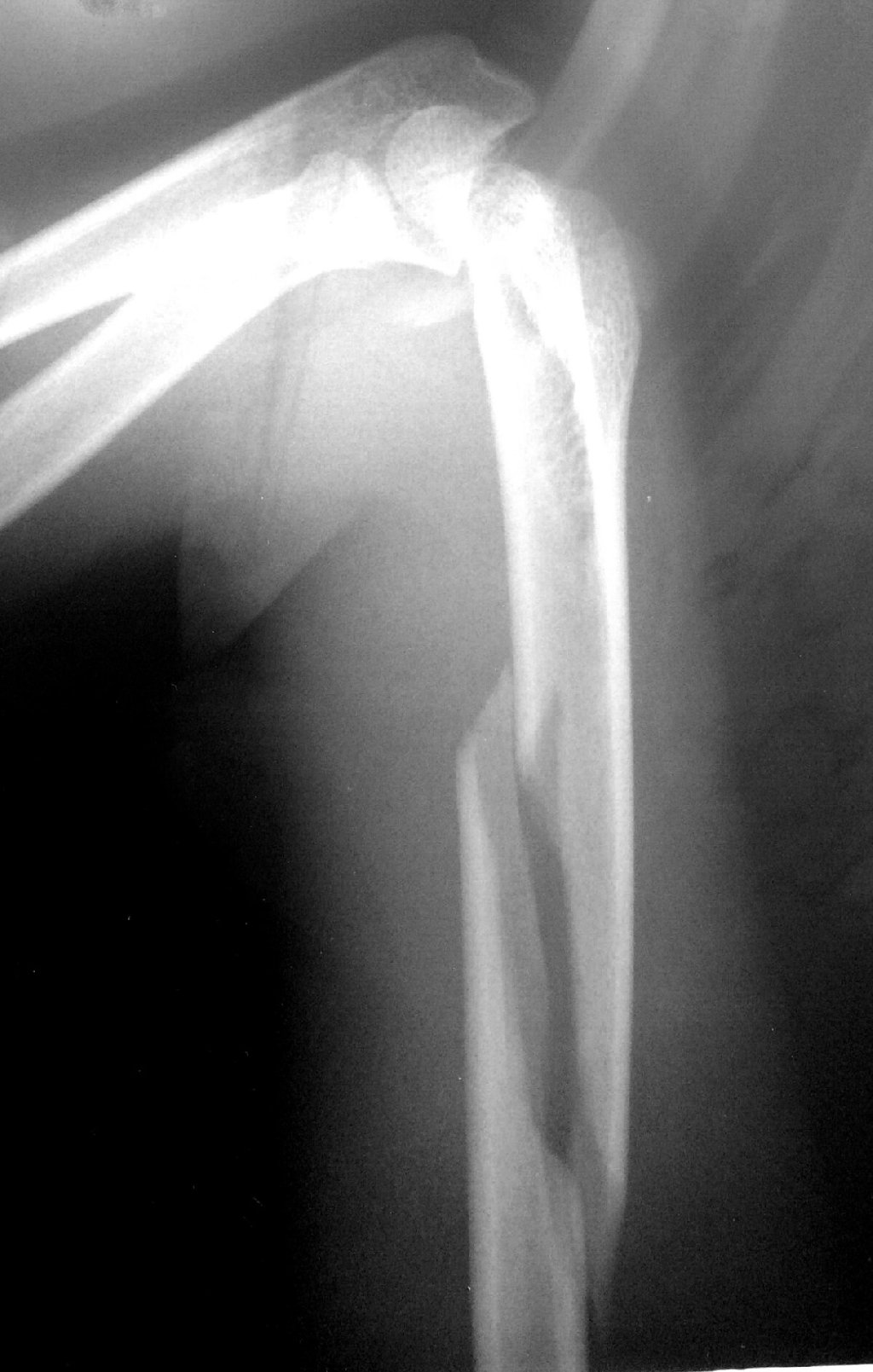 Çiyin sümüyünün sınıqları