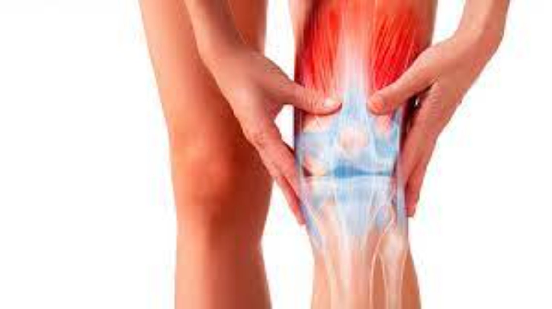 Dizdə artroskopik meniskektomiya (bərpası mümkün olmayan menisklərin artroskopik üsulla çıxarılması)