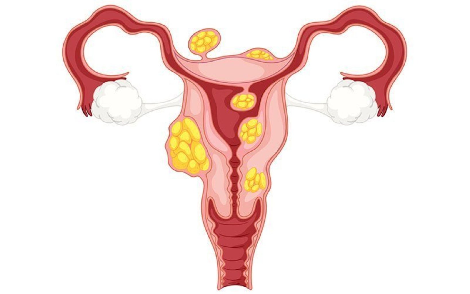 Iltihabi xəstəliklər (Endometrit, Salpingit, Ooforit, Kolpit ( vaginit), Servisit, Bartolinit, Vulvit)