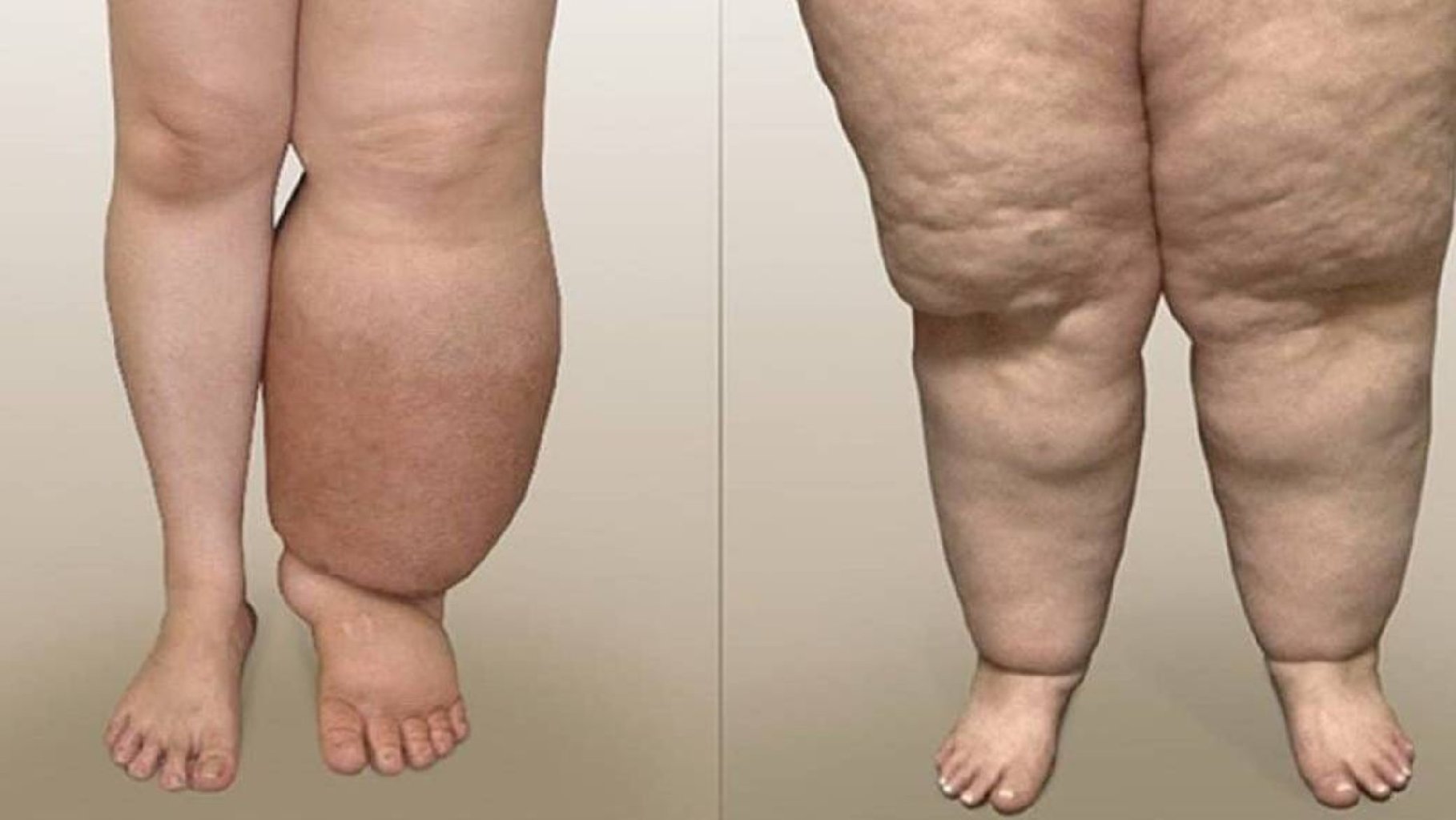 Lipedema Xəstəliyi: Səbəbləri, Müalicəsi və Həyat Tövsiyələri