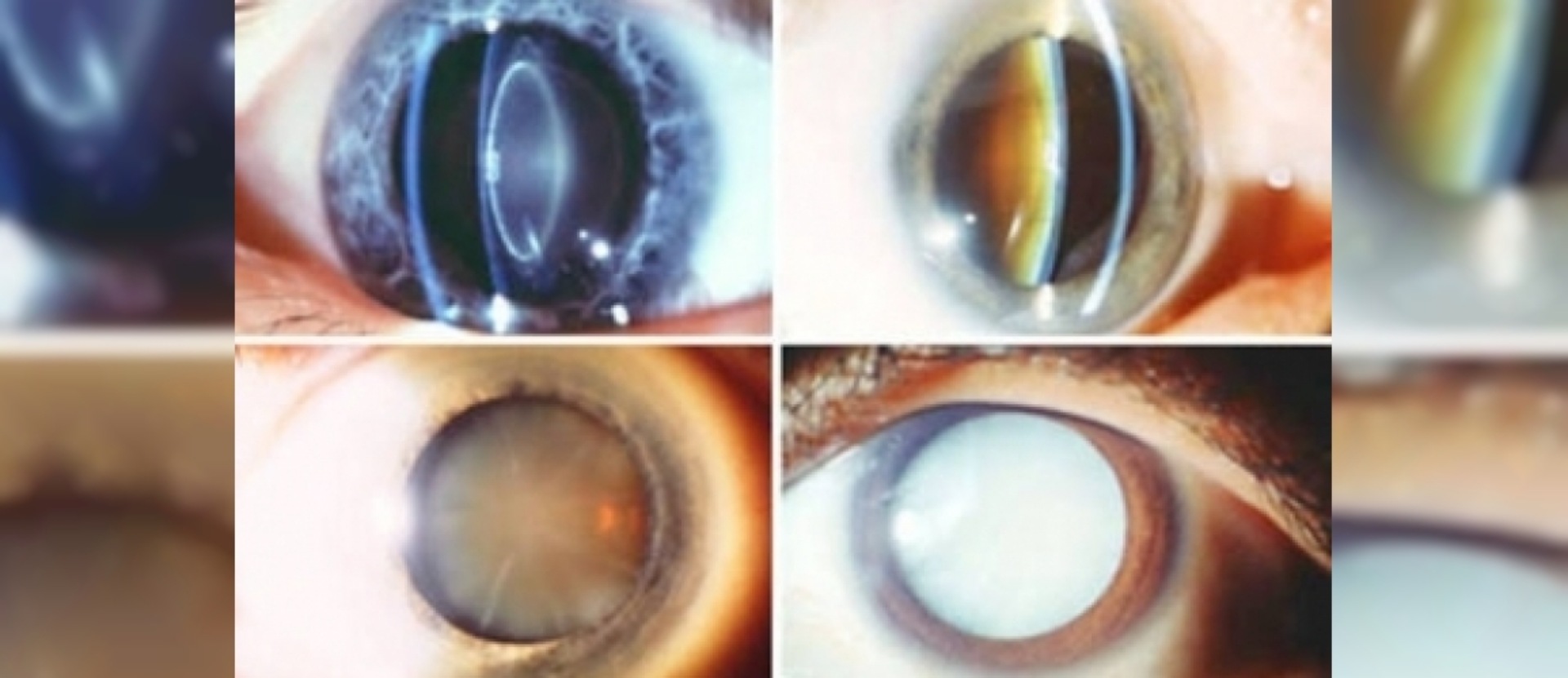 Katarakta xəstəliyi, diaqnoz və müalicə üsulları makalesi