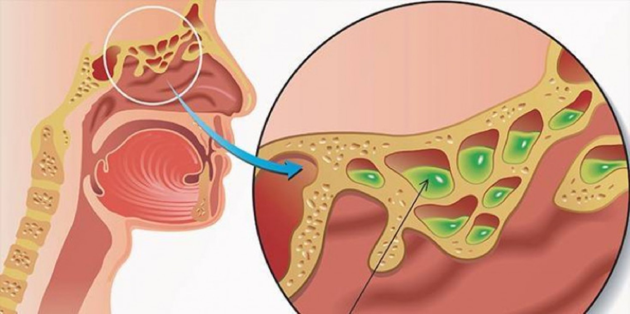 Allergik rinosinusopatiya