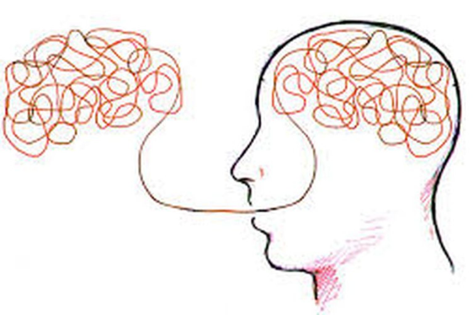 “Xarici aksent” sindromu