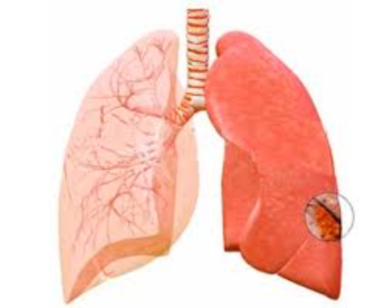 Ağciyər emboliyası