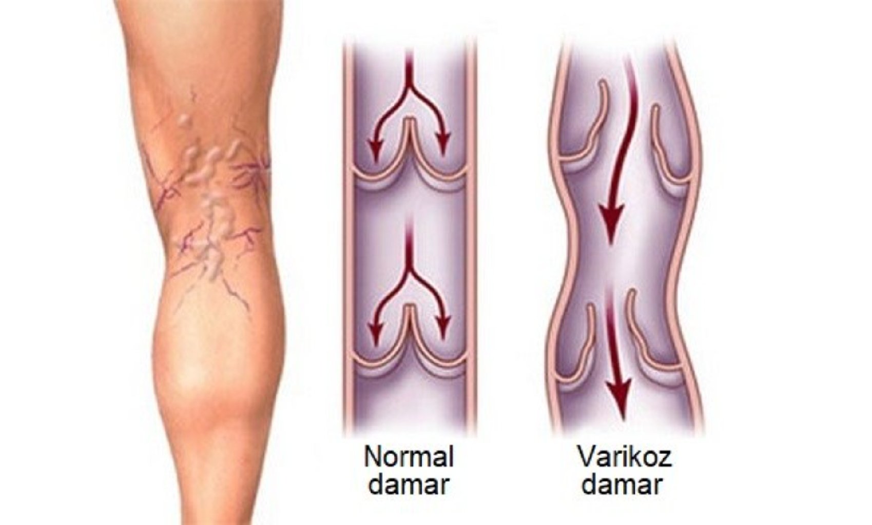 Aşağı ətrafların varikoz genəlməsi