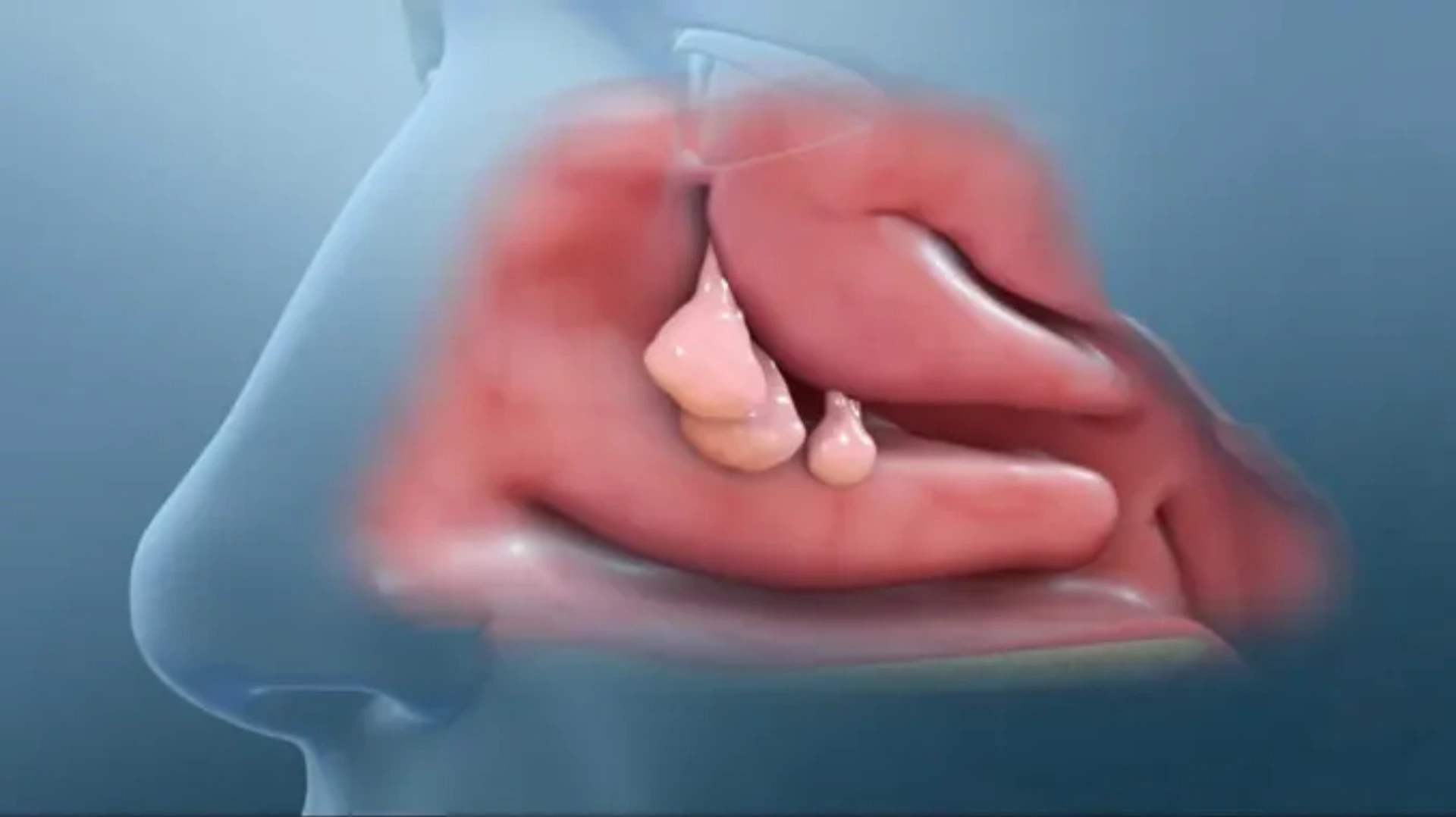 Konxa (Burun əti) xəstəliyi