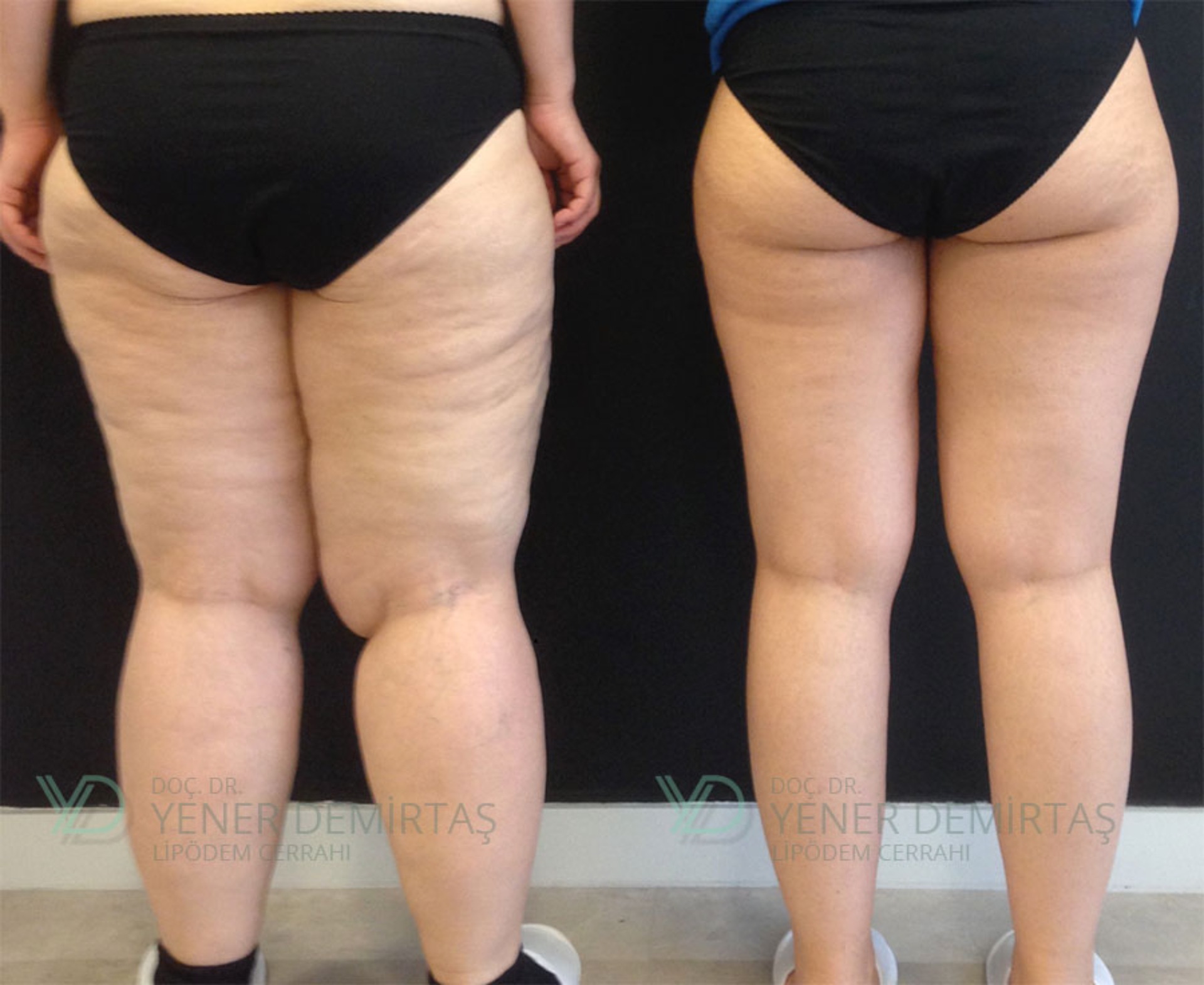Lipödem (Lipedema) Tedavisi makalesi