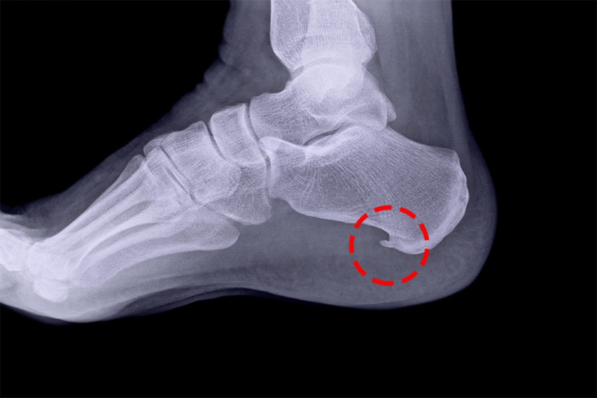 Daban tıxacları və müalicə üsulları makalesi