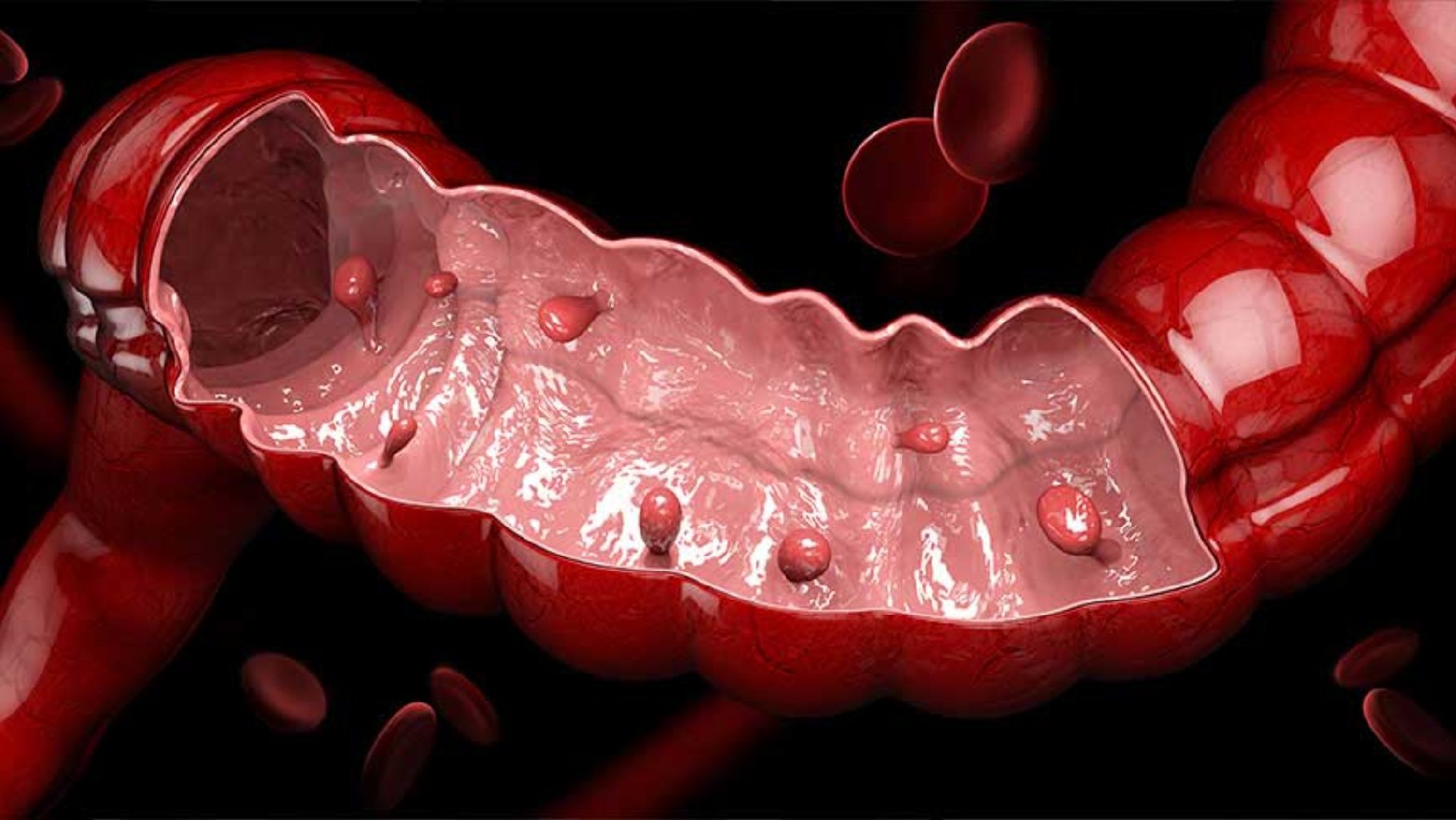 Anal polip xesteliyi